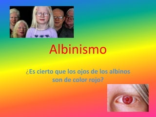 Albinismo ¿Es cierto que los ojos de los albinos son de color rojo? 