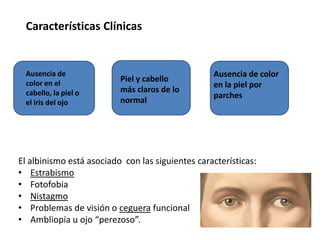 El albinismo está asociado con las siguientes características:
• Estrabismo
• Fotofobia
• Nistagmo
• Problemas de visión o ceguera funcional
• Ambliopía u ojo “perezoso”.
Ausencia de
color en el
cabello, la piel o
el iris del ojo
Piel y cabello
más claros de lo
normal
Ausencia de color
en la piel por
parches
Características Clínicas
 