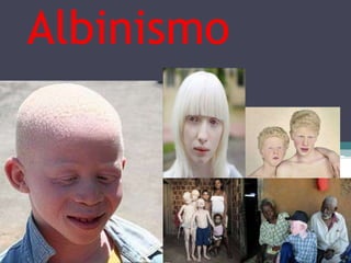 Albinismo

 
