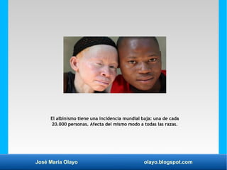 José María Olayo olayo.blogspot.com
El albinismo tiene una incidencia mundial baja: una de cada
20.000 personas. Afecta del mismo modo a todas las razas.
 