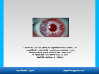 José María Olayo olayo.blogspot.com
El albinismo causa un déficit de pigmentación en la retina, iris
y coroides (revestimi...