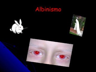 Albinismo 