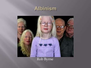 Albinism                                   Rob Byrne 