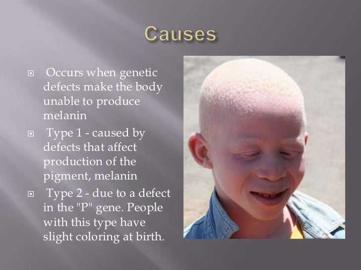 Albinism Albinism