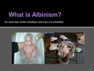 albinism | PPT