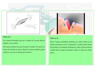Punto en U:
Es un punto hemostático por eso se emplea en vísceras macizas
(hígado). No es estético
Esta sutura continua evita que los puntos se aflojen. Se muestra la
técnica de retirada de suturas. Muestra la sutura mediante grapas
metálicas, así como la retirada de las mismas.
Punto en X:
Pasar la aguja ensamblada enhebrada por ambos bordes de la
herida, sacarla para volver a introducirla y, tomado ambos bordes
de la herida a un centímetro de distancia y sobre el borde contrario
a donde salió la aguja previamente, realizar el nudo con ambos
cabos.
 