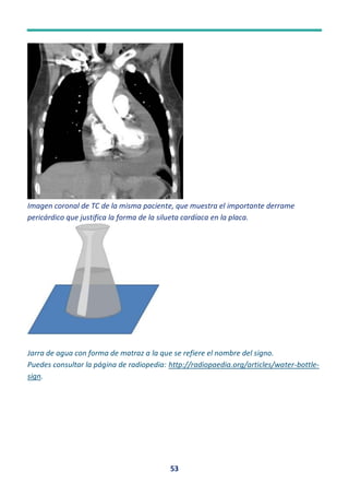 Pancake Sign Radiopedia Album_de_signos_Radiologicos_Semiologia_Radiologica_Eugenio_Navarro.pdf
