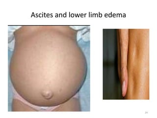 Ascites and lower limb edema
24
 