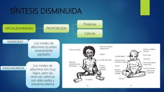 SÍNTESIS DISMINUIDA
HIPOALBUMINEMIA PROPORCION
Proteínas
Calorías
MARASMO
Los niveles de
albumina no están
severamente
agotados
KWASHIORKOR
Los niveles de
albumina son muy
bajos, pero las
reservas calóricas
son adecuadas y
presenta edema
 