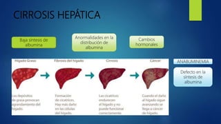 CIRROSIS HEPÁTICA
Baja síntesis de
albumina
Anormalidades en la
distribución de
albumina
Cambios
hormonales
ANABUMINEMIA
Defecto en la
síntesis de
albumina
 