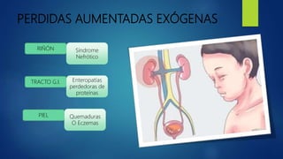 PERDIDAS AUMENTADAS EXÓGENAS
RIÑÓN
TRACTO G.I.
Síndrome
Nefrótico
Enteropatías
perdedoras de
proteínas
PIEL Quemaduras
O Eczemas
 