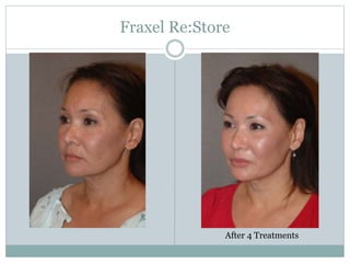Fraxel Re:Store 
After 4 Treatments 
 