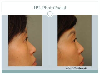 IPL PhotoFacial 
After 3 Treatments 
 