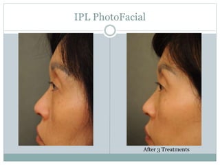 IPL PhotoFacial 
After 3 Treatments 
 