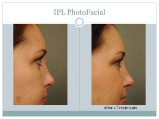 IPL PhotoFacial 
After 4 Treatments 
 