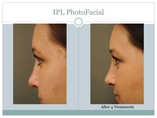 IPL PhotoFacial 
After 4 Treatments 
 