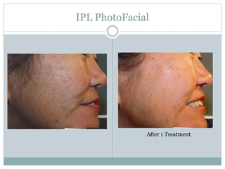 IPL PhotoFacial 
After 1 Treatment 
 
