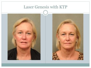 Laser Genesis with KTP 
 