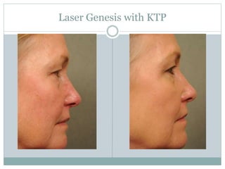 Laser Genesis with KTP 
 