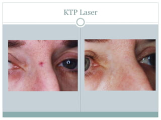 KTP Laser 
 
