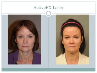 ActiveFX Laser 
 