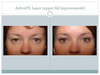 ActiveFX Laser (upper lid improvement) 
 