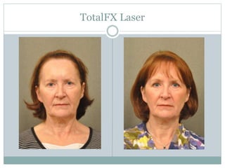 TotalFX Laser 
 