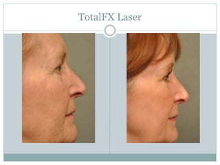 TotalFX Laser 
 