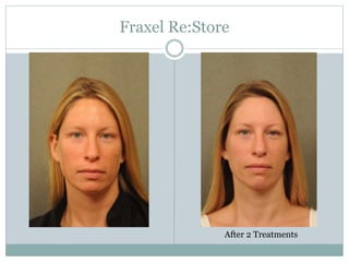 Fraxel Re:Store 
After 2 Treatments 
 