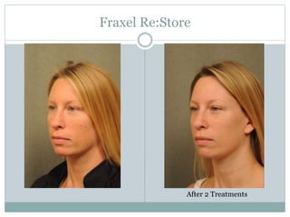 Fraxel Re:Store 
After 2 Treatments 
 