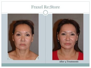 Fraxel Re:Store 
After 4 Treatments 
 