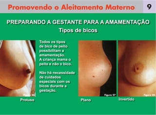 Promovendo o Aleitamento Materno
Todos os tipos
de bico de peito
possibilitam a
amamentação.
A criança mama o
peito e não o bico.
Não há necessidade
de cuidados
especiais com os
bicos durante a
gestação.
PREPARANDO A GESTANTE PARA A AMAMENTAÇÃO
Protuso Plano Invertido
9
Tipos de bicos
Figura 28Figura 27Figura 26
 