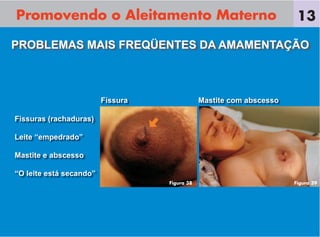 Promovendo o Aleitamento Materno
Fissuras (rachaduras)
Leite “empedrado”
Mastite e abscesso
“O leite está secando”
PROBLEMAS MAIS FREQÜENTES DA AMAMENTAÇÃO
13
Fissura Mastite com abscesso
Figura 38 Figura 39
 