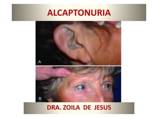 ALCAPTONURIA




DRA. ZOILA DE JESUS
 