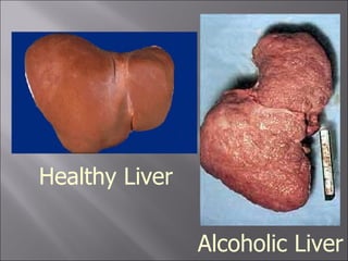 Healthy Liver Alcoholic Liver 