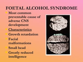 FOETAL ALCOHOL SYNDROME Most common preventable cause of adverse CNS development Characteristics Growth retardation Facial malformations Small head Greatly reduced intelligence 