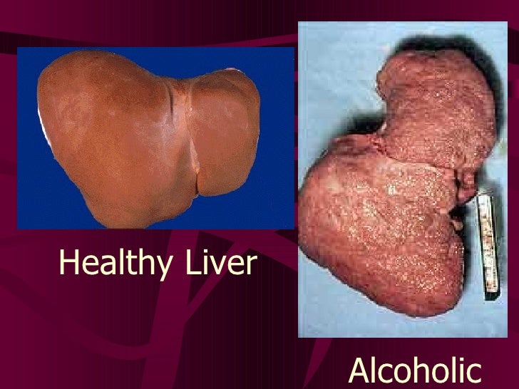 Alcohol Hepatitis After Binge Drinking Alcohol Hepatitis After Binge Drinking