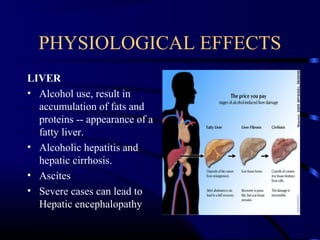 PHYSIOLOGICAL EFFECTS
LIVER
• Alcohol use, result in
accumulation of fats and
proteins -- appearance of a
fatty liver.
• Alcoholic hepatitis and
hepatic cirrhosis.
• Ascites
• Severe cases can lead to
Hepatic encephalopathy
 