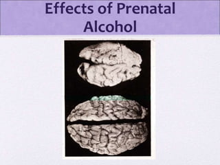 Effects of Prenatal
Alcohol
 
