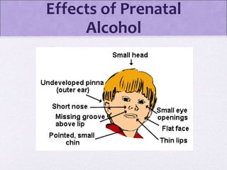 Effects of Prenatal
Alcohol
 