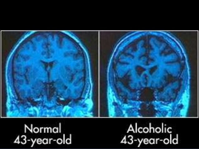 Alcohol Dependence