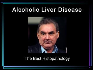 Alcoholic Liver Disease
The Best Histopathology
 