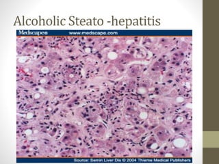 Alcoholic Steato -hepatitis
 