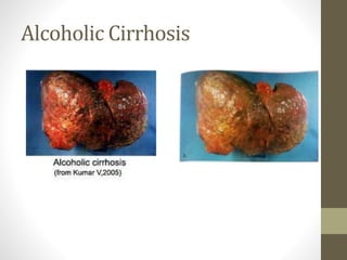 Alcoholic Cirrhosis
 