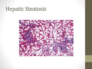 Hepatic Steatosis
 