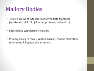 Mallory Bodies
• Tangled skeins of cytokeratin intermediate filaments
(cytokeratin 8 & 18…) & other proteins ( ubiquitin..).
• Eosinophilic cytoplasmic inclusions.
• Primary biliary cirrhosis, Wilson disease, chronic cholestatic
syndromes & hepatocellular tumors.
 