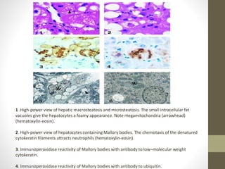 1 .High-power view of hepatic macrosteatosis and microsteatosis. The small intracellular fat
vacuoles give the hepatocytes a foamy appearance. Note megamitochondria (arrowhead)
(hematoxylin-eosin).
2. High-power view of hepatocytes containing Mallory bodies. The chemotaxis of the denatured
cytokeratin filaments attracts neutrophils (hematoxylin-eosin).
3. Immunoperoxidase reactivity of Mallory bodies with antibody to low–molecular weight
cytokeratin.
4. Immunoperoxidase reactivity of Mallory bodies with antibody to ubiquitin.
 