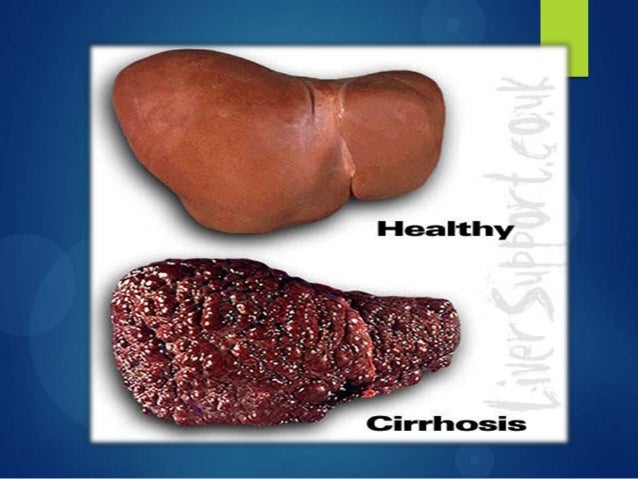 Liver Disease After Years Of Drinking Alcohol Liver Disease After Years Of Drinking Alcohol