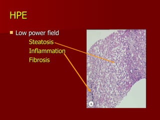 HPE Low power field Steatosis Inflammation Fibrosis 