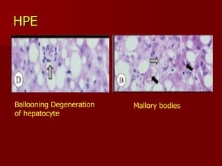 HPE Ballooning Degeneration of hepatocyte  Mallory bodies 